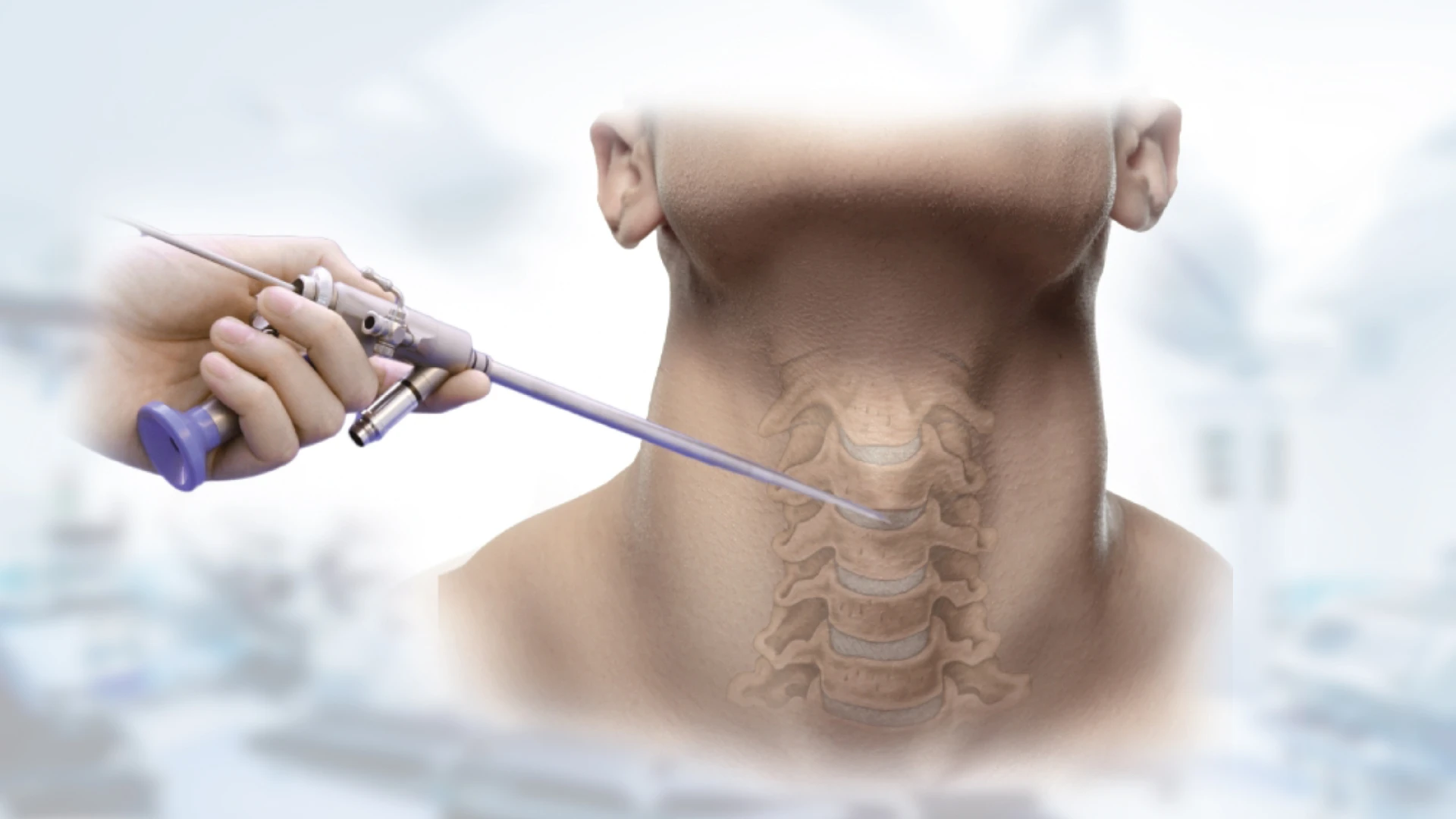 Endoscopic ACDF