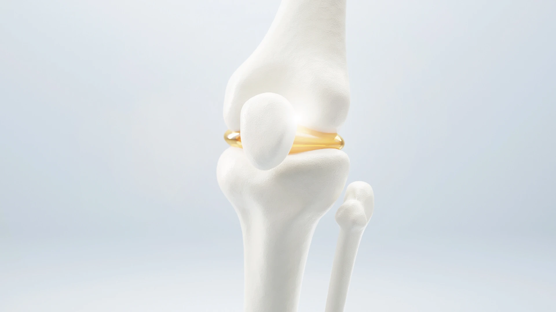 ซ่อมแซมหมอนรองกระดูกข้อเข่า (Meniscus Repair)