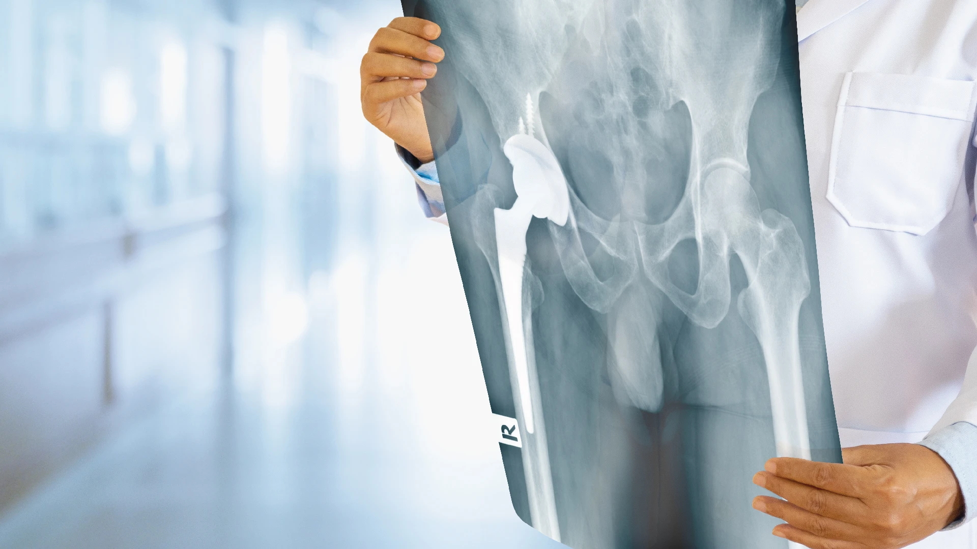 ผ่าตัดเปลี่ยนข้อสะโพก  (Total Hip Arthroplasty)