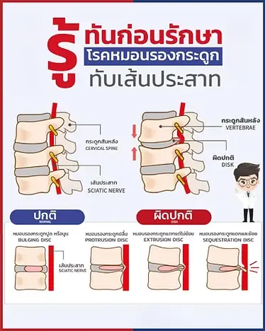 หมอนรองกระดูกทับเส้น
