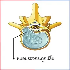 โรคกระดูกทับเส้น